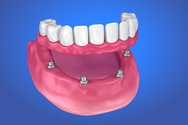 All-on-4 Dental Implants Odessa, TX
