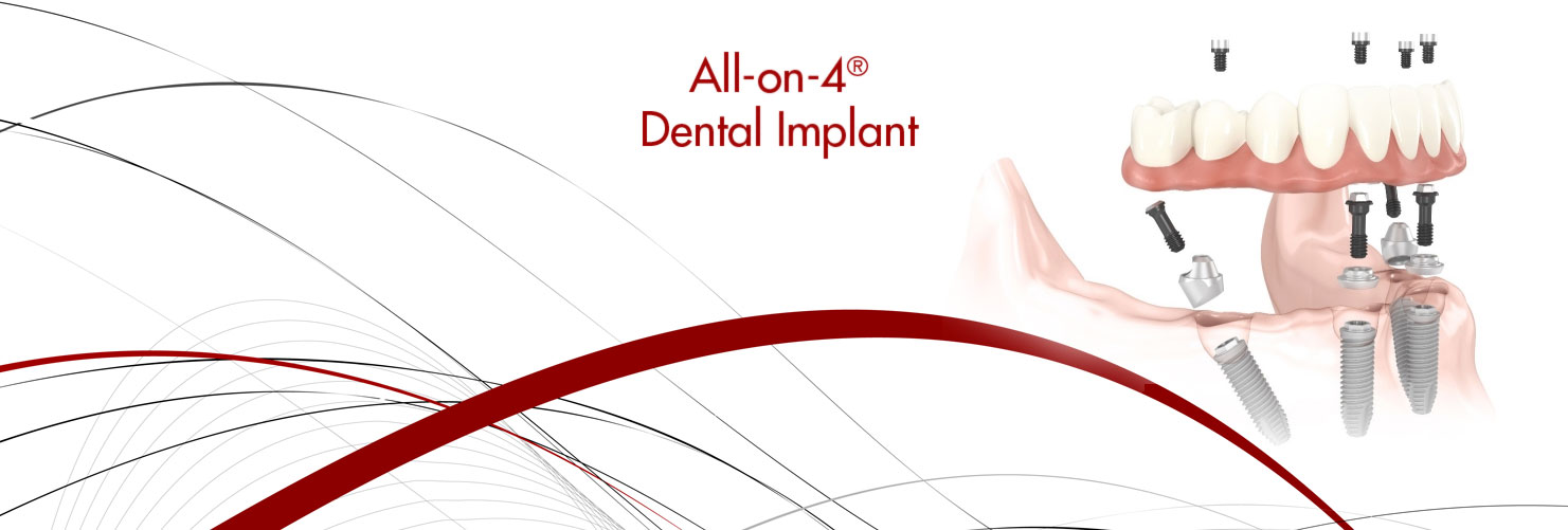 Odessa All-on-4 Dental Implants