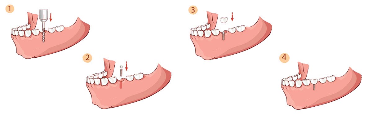 Odessa The Dental Implant Procedure