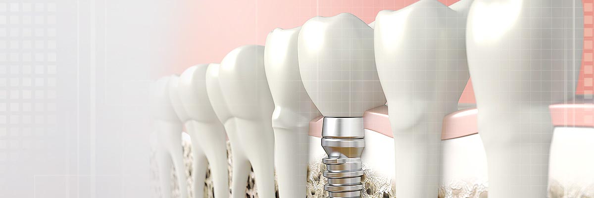 Odessa Implant Dentist