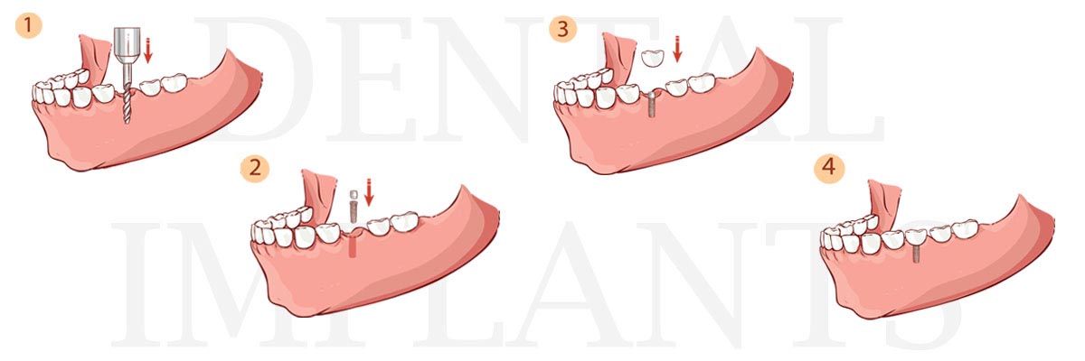 Odessa The Difference Between Dental Implants and Mini Dental Implants