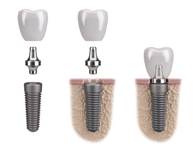 Mini Dental Implants