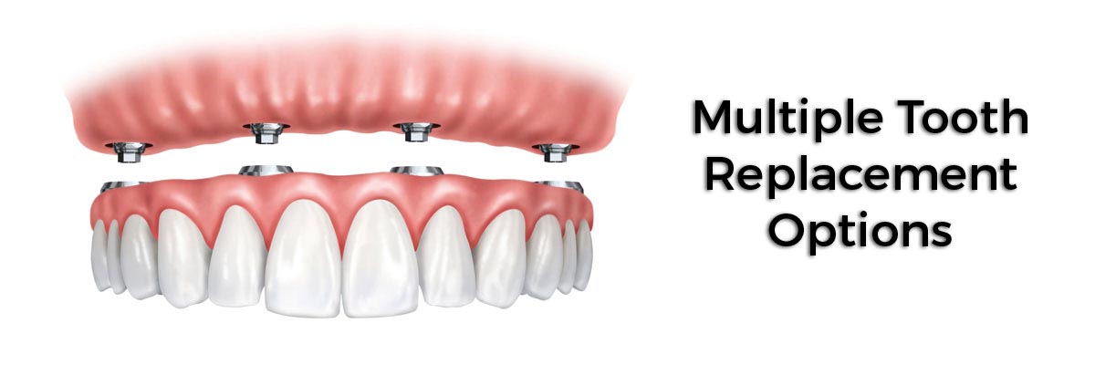 Odessa Multiple Teeth Replacement Options