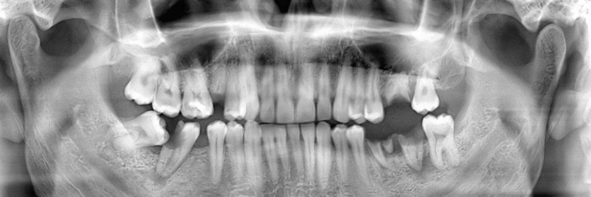 Odessa Options for Replacing Missing Teeth