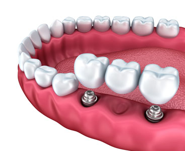 Implant Supported Dentures