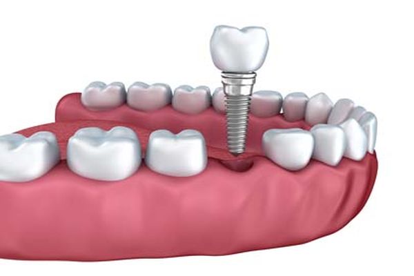 Tooth Replacement